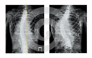 X-rays of human spine showing curvature. Patients suffering from scoliosis