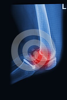 X Rays image broken knee joint with implant