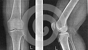 X-rays of knee joint in two projections