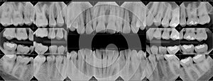 X-rays of My Teeth photo