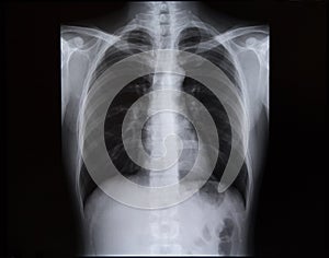 X-rays of the spine and chest