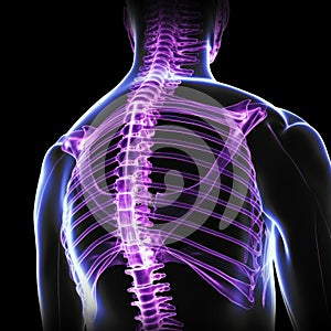 x-rays of the spine, Scoliosis film x-ray show spinal bend in teenager patient