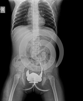 Xray abdomen