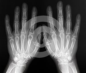 Xray of both hands - radiography