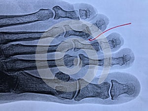 Xray of broken fourth toe