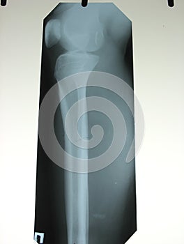 xray of a broken leg bone