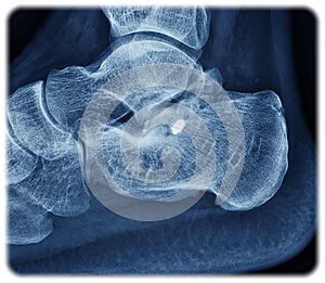 Xray calcaneus