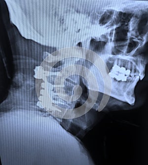 Xray cervical spine fixation hardware after car accident