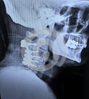 Xray cervical spine fixation hardware after car accident photo