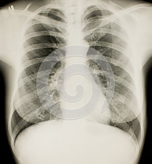 Xray of chest, normal