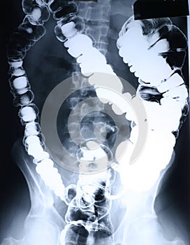 Xray/Colon