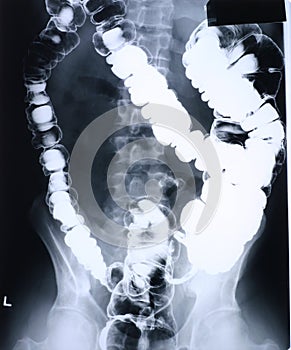 Xray/colon