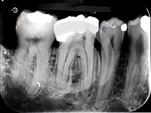 Xray dental film amalgam filling