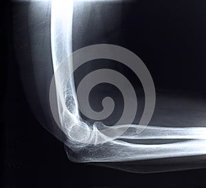 Xray/Elbow side