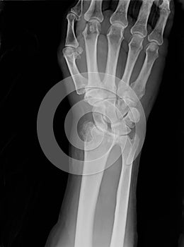 Xray of epiphysial radial fracture reduced with permanent synthetic means