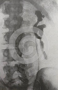 Xray examination abdomen kidney shrapnel war victim