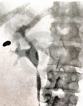 Xray examination abdomen kidneys  shrapnel war victim photo