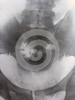 Xray examination abdomen pelvis shrapnel war victim