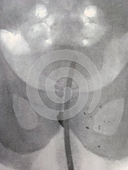 Xray examination abdomen pelvis shrapnel war victim photo