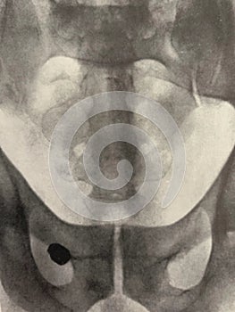 Xray examination abdomen pelvis shrapnel war victim photo