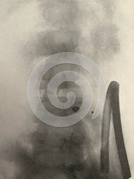Xray examination abdomen ureter shrapnel war victim photo