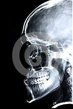 Xray/Face side