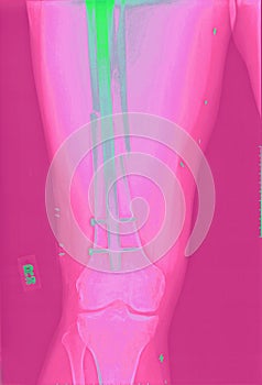 Xray of Femur Fracture Repair