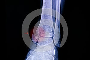 Xray film of an ankle with medial malleolus fracture photo