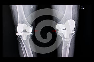 Xray film of both knees arthroplasty