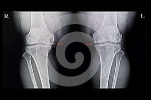 Xray film of both knees osteoarhthritis