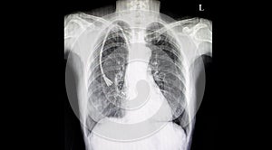 Xray Film of Double Lumen Catheter