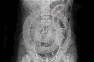 Xray film of a patient with left ureteric stent