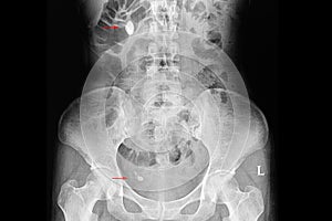 Xray film of a patient with multiple kidney and ureteric stones