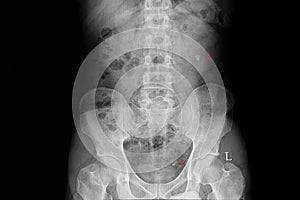 Xray film of a patient with renal and ureteric stone