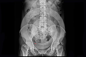 Xray film of a patient with right distal ureteric stone