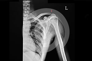 X ray of a patient with fracture acromion photo