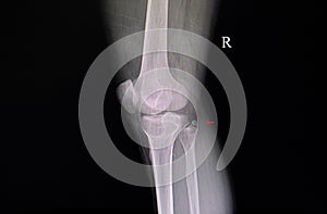 Xray film showing fracturede proximal fibular photo