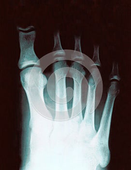 Xray of foot