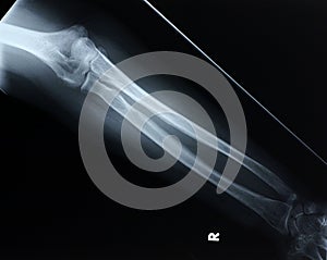 Xray/Forearm front photo