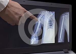 Xray of fracture of a hand and hand after operation