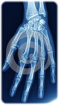 Xray hand