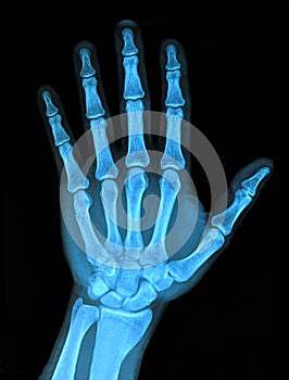 Xray hand
