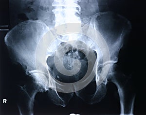 Xray/Hip
