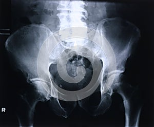 Xray/hip