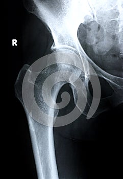 Xray/Hip Front