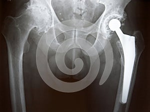Xray of Hip Replacement