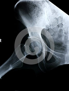 Xray/Hip side