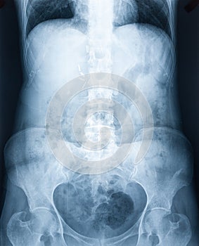 Xray of a human abdomen