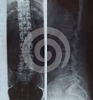 Xray of human spine
