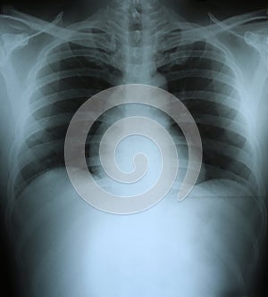 Xray of a human thorax
